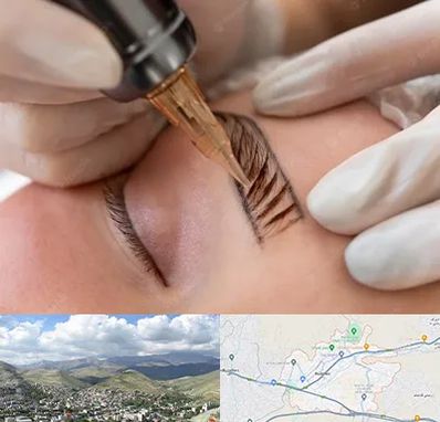 میکروبلیدینگ در رودهن