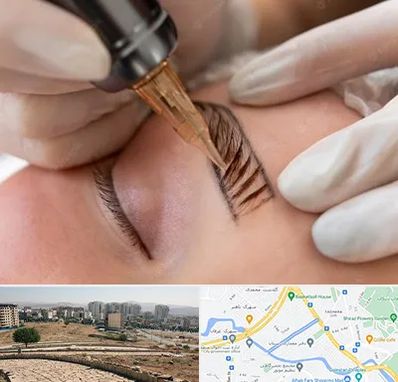 میکروبلیدینگ در کوی وحدت شیراز