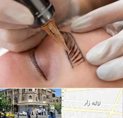 میکروبلیدینگ در لاله زار