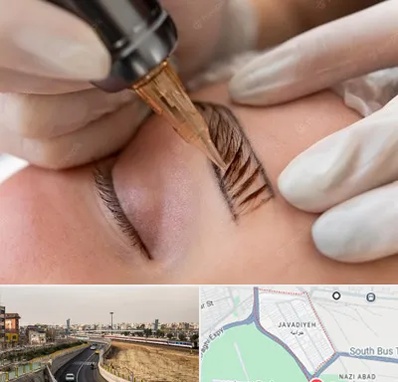 میکروبلیدینگ در جوادیه