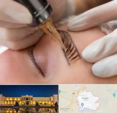 میکروبلیدینگ در برازجان