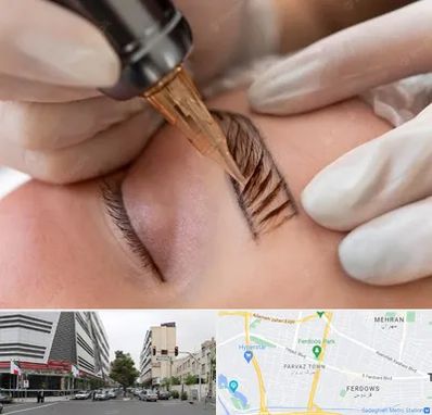 میکروبلیدینگ در بلوار فردوس