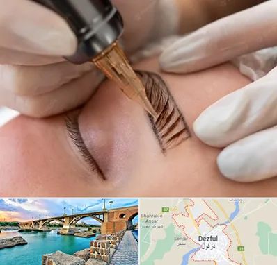 میکروبلیدینگ در دزفول