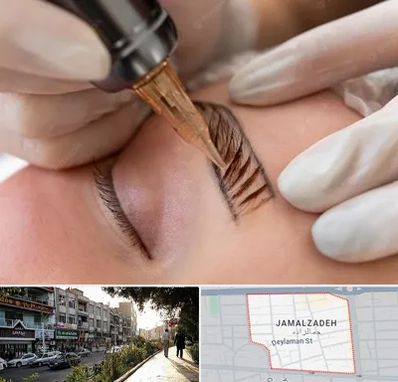 میکروبلیدینگ در خیابان جمالزاده