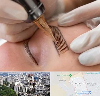 میکروبلیدینگ در ولنجک