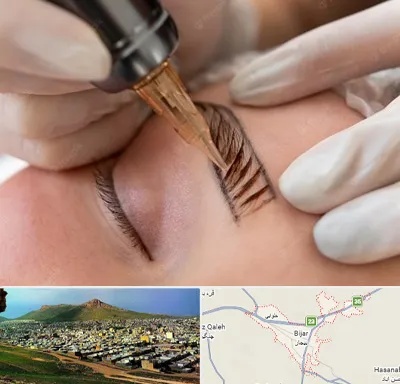 میکروبلیدینگ در بیجار