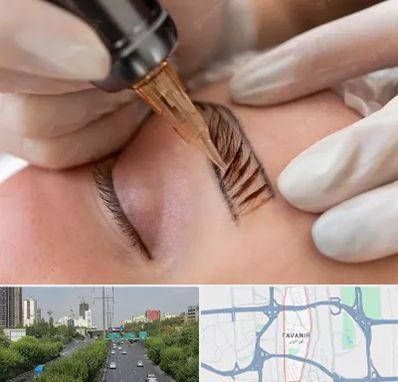 میکروبلیدینگ در توانیر