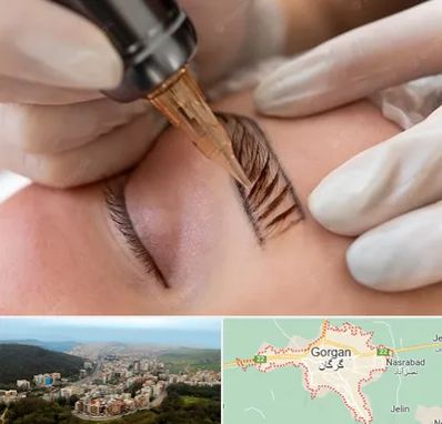 میکروبلیدینگ در گرگان