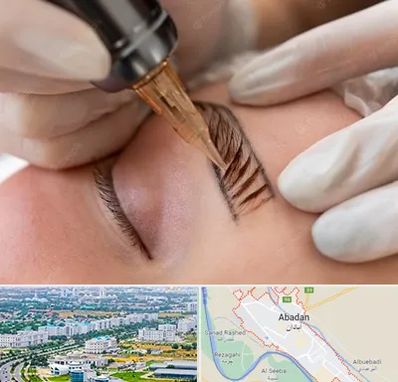 میکروبلیدینگ در آبادان