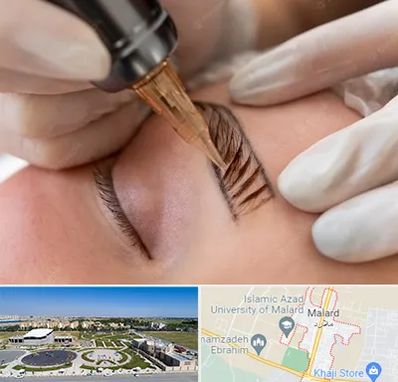 میکروبلیدینگ در ملارد