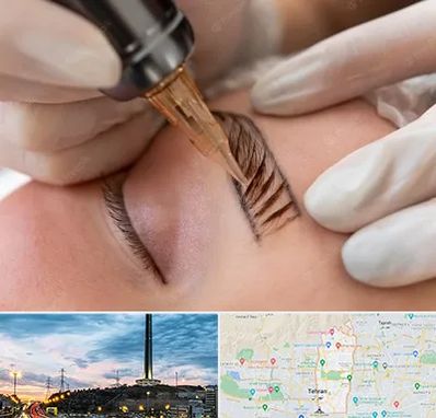 میکروبلیدینگ در منطقه 2 تهران