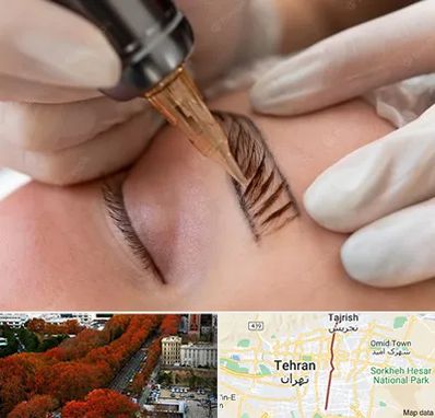 میکروبلیدینگ در ولیعصر