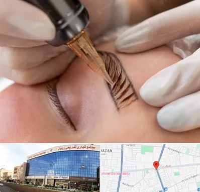 میکروبلیدینگ در نصف راه تبریز