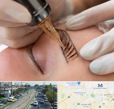 میکروبلیدینگ در جنوب تهران