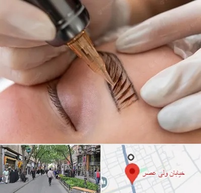 میکروبلیدینگ در ولیعصر شهریار