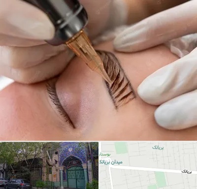 میکروبلیدینگ در بریانک