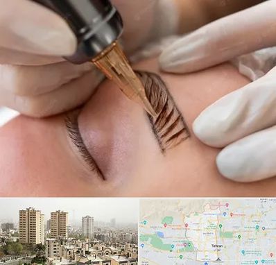 میکروبلیدینگ در منطقه 5 تهران