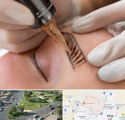 میکروبلیدینگ در شاهین ویلا کرج