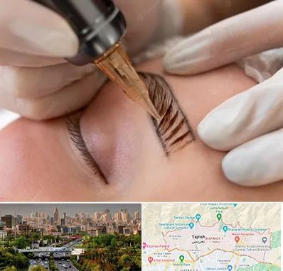 میکروبلیدینگ در منطقه 1 تهران