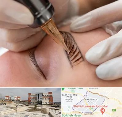 میکروبلیدینگ در حکیمیه