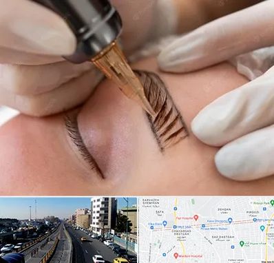 میکروبلیدینگ در پیروزی