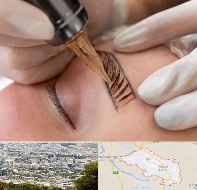 میکروبلیدینگ در یاسوج