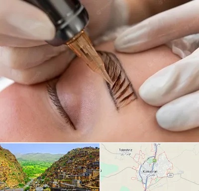 میکروبلیدینگ در کامیاران