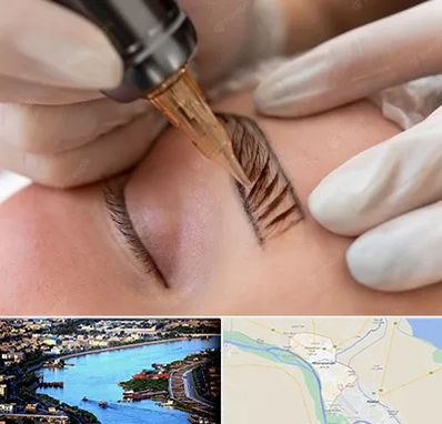 میکروبلیدینگ در خرمشهر