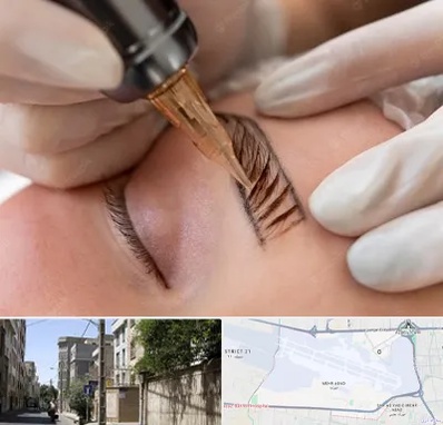 میکروبلیدینگ در مهرآباد