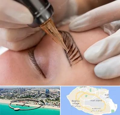 میکروبلیدینگ در کیش