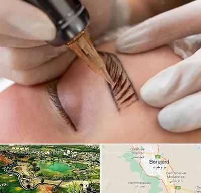 میکروبلیدینگ در بروجرد