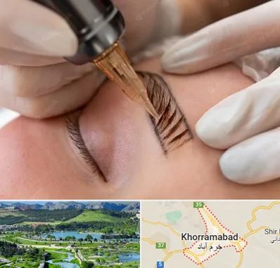 میکروبلیدینگ در خرم آباد