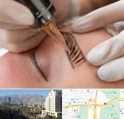 میکروبلیدینگ در حقانی