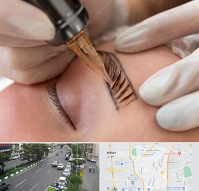 میکروبلیدینگ در ستارخان