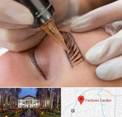 میکروبلیدینگ در باغ فردوس