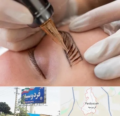 میکروبلیدینگ در فردوسیه شهریار