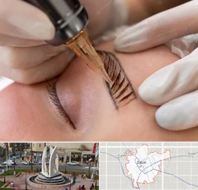 میکروبلیدینگ در زابل