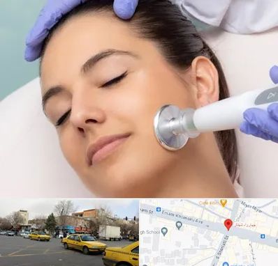 پلاسما جت در شهناز تبریز