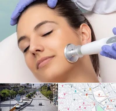 پلاسما جت در خیابان زند شیراز