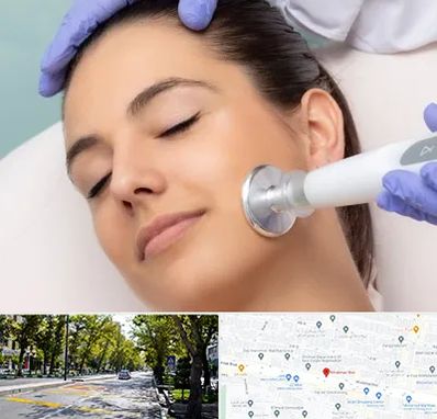 پلاسما جت در میرداماد