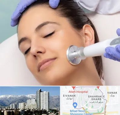 پلاسما جت در شهرک غرب تهران