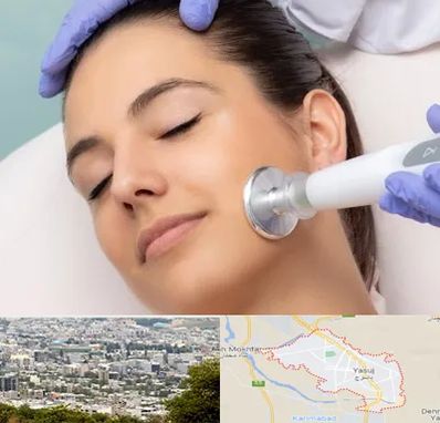 پلاسما جت در یاسوج