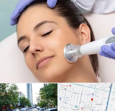 پلاسما جت در امامت مشهد