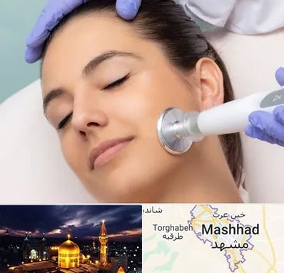پلاسما جت در مشهد