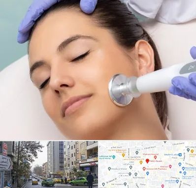 پلاسما جت در فاطمی