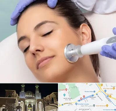 پلاسما جت در زرگری شیراز