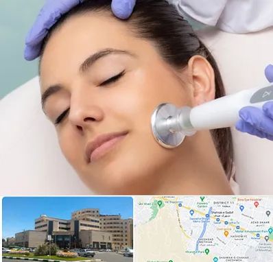 پلاسما جت در صیاد شیرازی مشهد