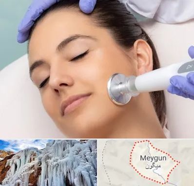 پلاسما جت در میگون