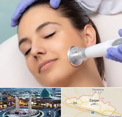 پلاسما جت در زنجان