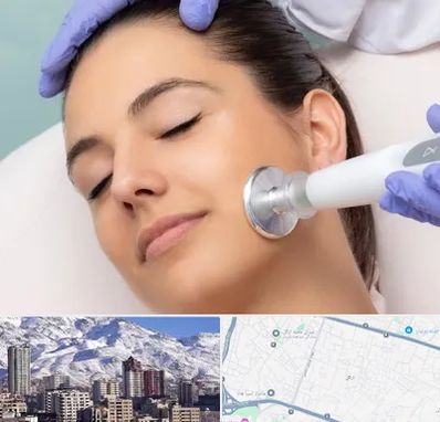 پلاسما جت در ازگل